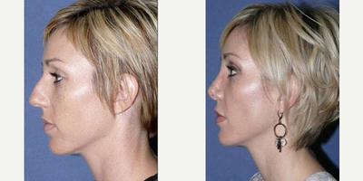 Case 4167 - Woman treated with Rhinoplasty