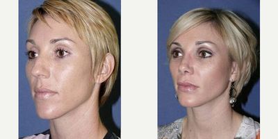 Case 4168 - Woman treated with Rhinoplasty