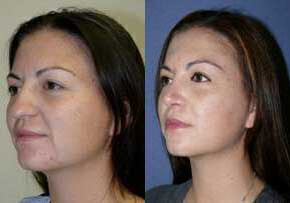 Case 4169 - Woman treated with Rhinoplasty