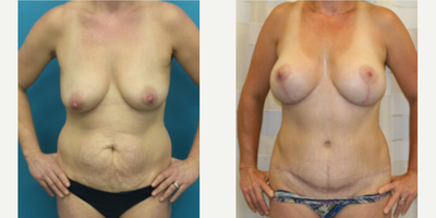 Case 417 - Woman treated with Tummy Tuck