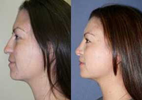 Case 4170 - Woman treated with Rhinoplasty