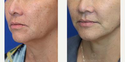 Case 4176 - Woman treated with Facelift