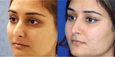Case 4177 - woman treated with Rhinoplasty