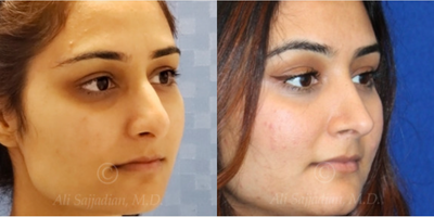 Case 4178 - woman treated with Rhinoplasty
