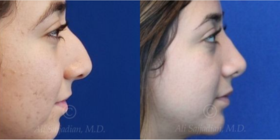 Case 4179 - woman treated with Rhinoplasty