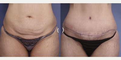 Case 418 - 25-34 year old woman treated with Tummy Tuck, Liposuction