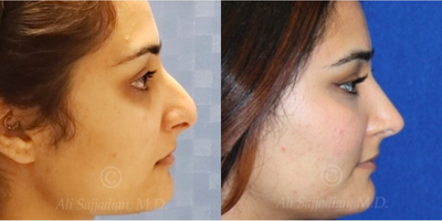 Case 4180 - woman treated with Rhinoplasty