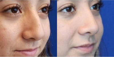 Case 4181 - woman treated with Rhinoplasty