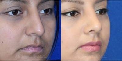 Case 4182 - woman treated with Rhinoplasty