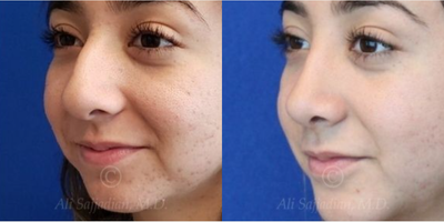 Case 4183 - woman treated with Rhinoplasty