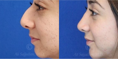 Case 4184 - woman treated with Rhinoplasty