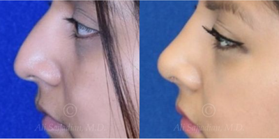 Case 4185 - woman treated with Rhinoplasty