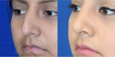 Case 4186 - woman treated with Rhinoplasty