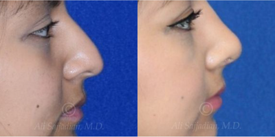 Case 4187 - woman treated with Rhinoplasty