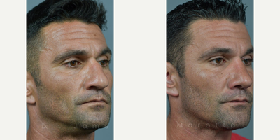 Case 4188 - Man treated with Rhinoplasty