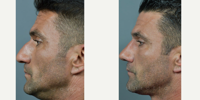 Case 4189 - Man treated with Rhinoplasty