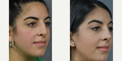 Case 4191 - Woman treated with Rhinoplasty
