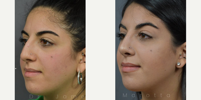 Case 4192 - Woman treated with Rhinoplasty