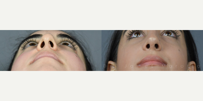 Case 4193 - Woman treated with Rhinoplasty