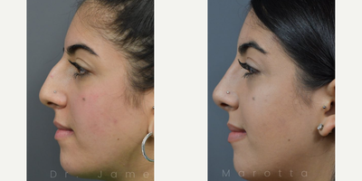 Case 4194 - Woman treated with Rhinoplasty