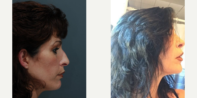 Case 4195 - Woman treated with Rhinoplasty