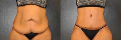 Case 42 - Woman treated with Tummy Tuck