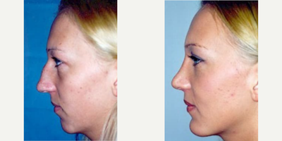 Case 4200 - Woman treated with Rhinoplasty