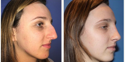 Case 4201 - Woman treated with Rhinoplasty