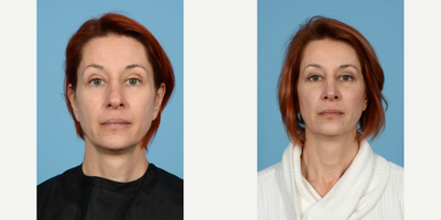 Case 4202 - 45-54 year old woman treated with Rhinoplasty