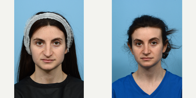 Case 4203 - 25-34 year old woman treated with Rhinoplasty