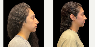 Case 4204 - 18-24 year old woman treated with Rhinoplasty