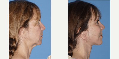 Case 4205 - 55-64 year old woman treated with Rhinoplasty