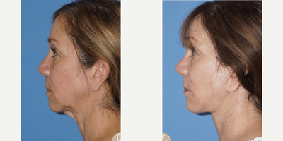 Case 4206 - 55-64 year old woman treated with Rhinoplasty