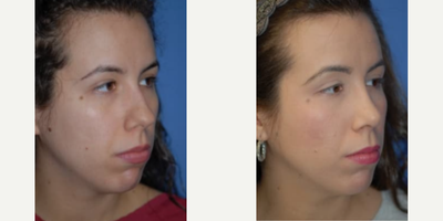Case 4208 - Woman treated with Rhinoplasty