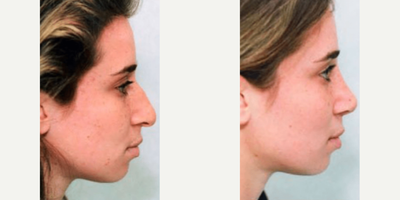 Case 4209 - Woman treated with Rhinoplasty