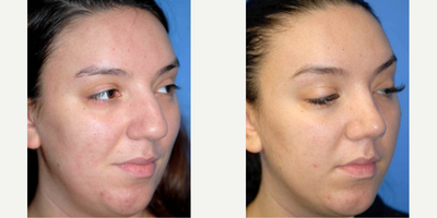 Case 4210 - Woman treated with Rhinoplasty