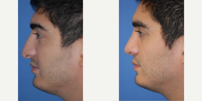 Case 4211 - Man treated with Rhinoplasty