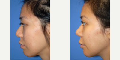 Case 4212 - Woman treated with Rhinoplasty