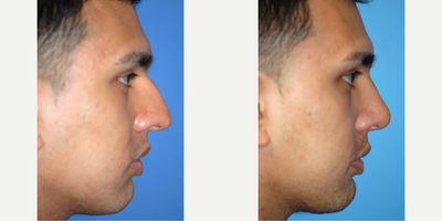 Case 4213 - Man treated with Rhinoplasty