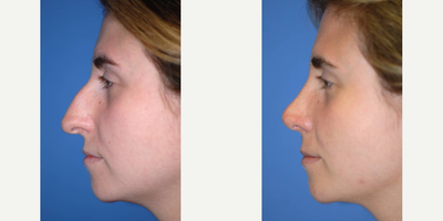 Case 4214 - Woman treated with Rhinoplasty