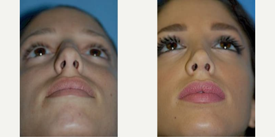 Case 4215 - 22 year old woman treated with Rhinoplasty