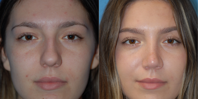 Case 4216 - 18-24 year old woman treated with Rhinoplasty