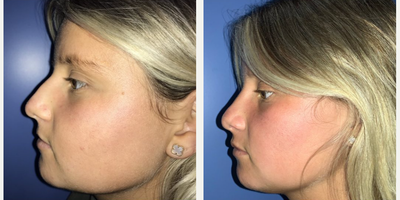Case 4217 - Woman treated with Rhinoplasty