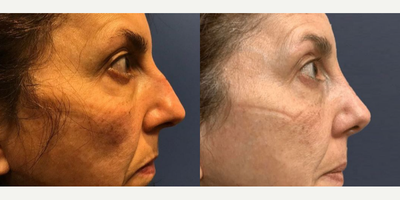 Case 4218 - Woman treated with Rhinoplasty