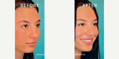 Case 4220 - Woman treated with Rhinoplasty