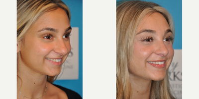 Case 4221 - Woman treated with Rhinoplasty