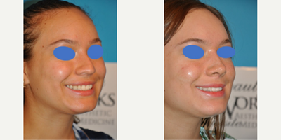Case 4222 - Woman treated with Rhinoplasty