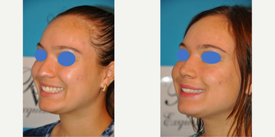 Case 4223 - Woman treated with Rhinoplasty