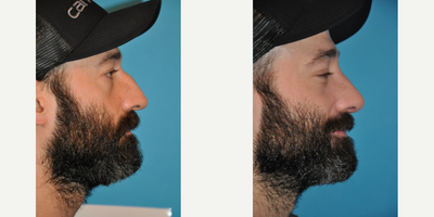 Case 4224 - Man treated with Rhinoplasty