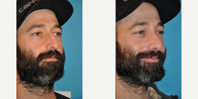 Case 4225 - Man treated with Rhinoplasty